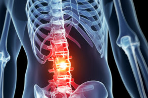 Spinal Injury Lawyer in Raleigh, NC