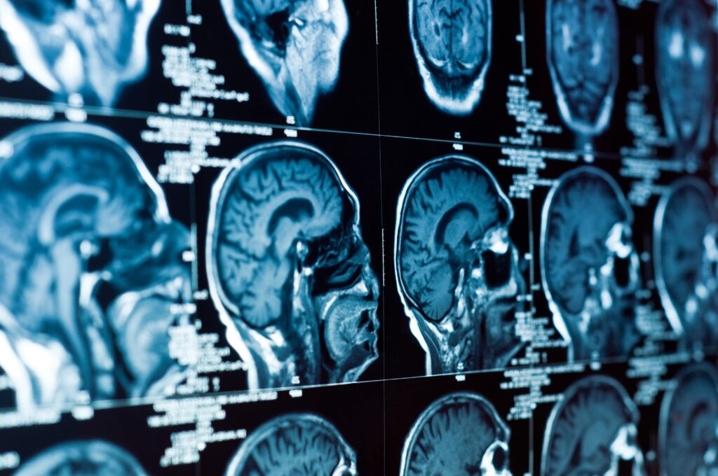 brain injury lawyer Chapel Hill, NC