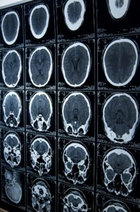 Brain Injury Lawyer in Raleigh, NC