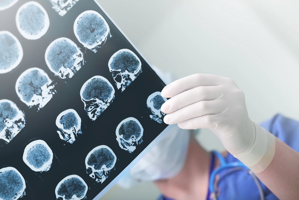 Brain Injuries